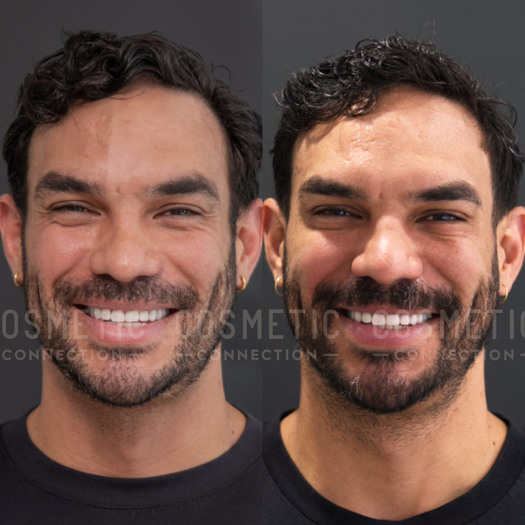 A smiling man is shown in two side-by-side photos, both with a gray background. The left photo shows him with clear skin, and the right photo shows subtle marks on his face. He has short, curly hair and a beard.