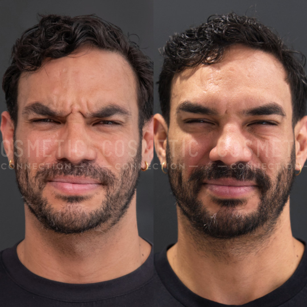 Side-by-side comparison of a person making different facial expressions. On the left, they appear to be frowning, and on the right, they are smiling slightly with closed eyes. The background is neutral.