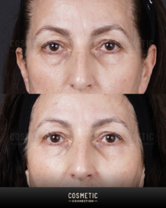Before-and-after photos of a womans face showing reduced wrinkles and smoother skin around the eyes, likely after a cosmetic procedure. The images display subtle but visible improvements.
