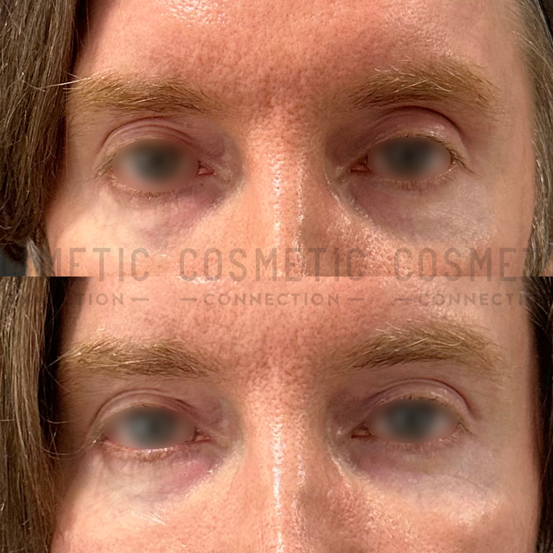 Close-up comparison of a persons eye area before and after a cosmetic procedure. The top image shows the eyes with visible dark circles and wrinkles, while the bottom image shows smoother skin and reduced discoloration.