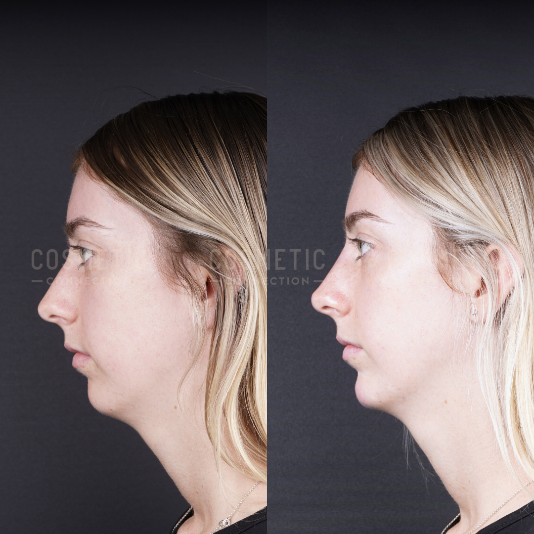 Side-by-side photos of a woman with blonde hair showing her profile before (left) and after (right) a cosmetic procedure, highlighting a more defined chin and jawline in the after image.