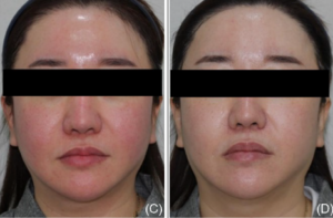 Two side-by-side photos of a woman with a black bar obscuring her eyes. The left image shows her face with redness, while the right image shows reduced redness and a more even skin tone.