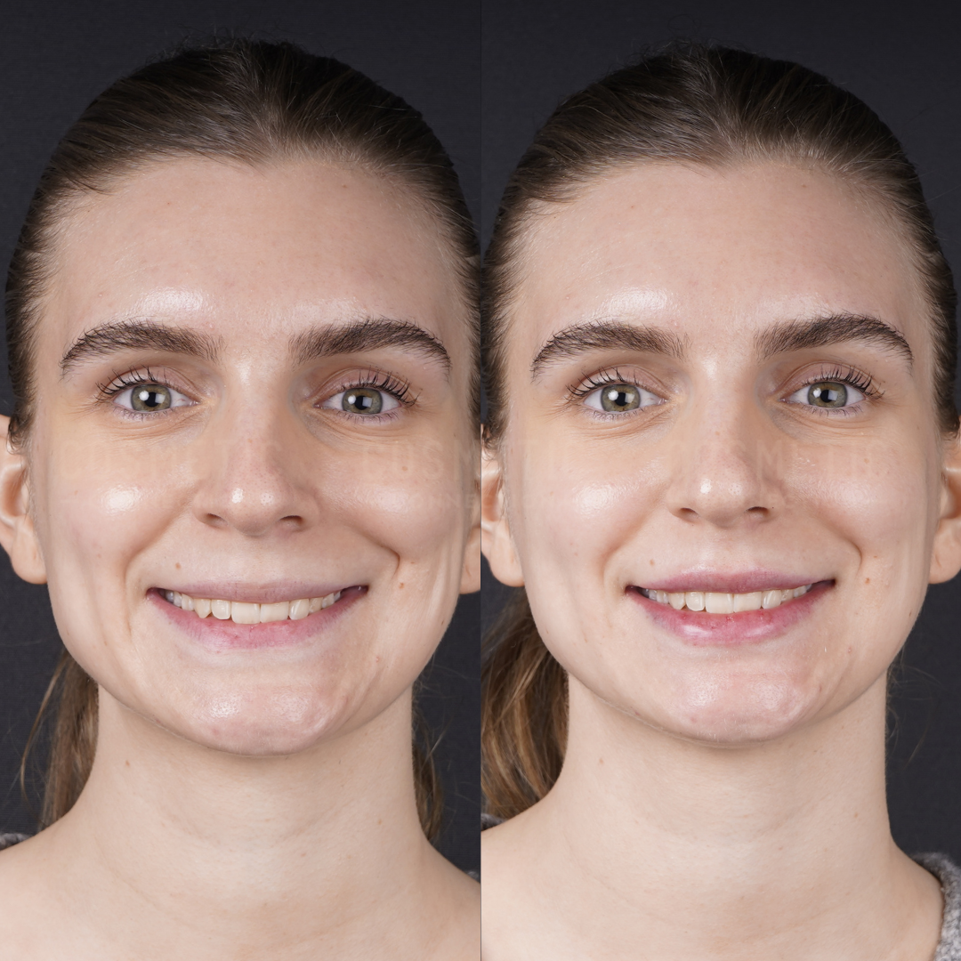 Side-by-side photos of a woman with light skin and brown hair pulled back, smiling at the camera. The left image shows her before, and the right image shows her after a cosmetic or skincare change.