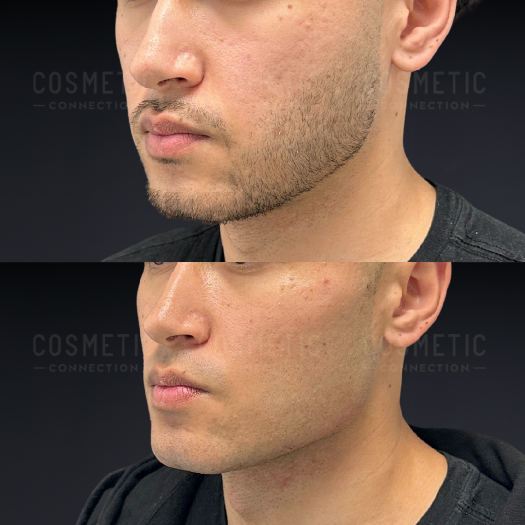 Side-by-side before and after photos of a man’s lower face and jawline, showing a defined beard in the top image and a clean-shaven, smooth jawline in the bottom image.