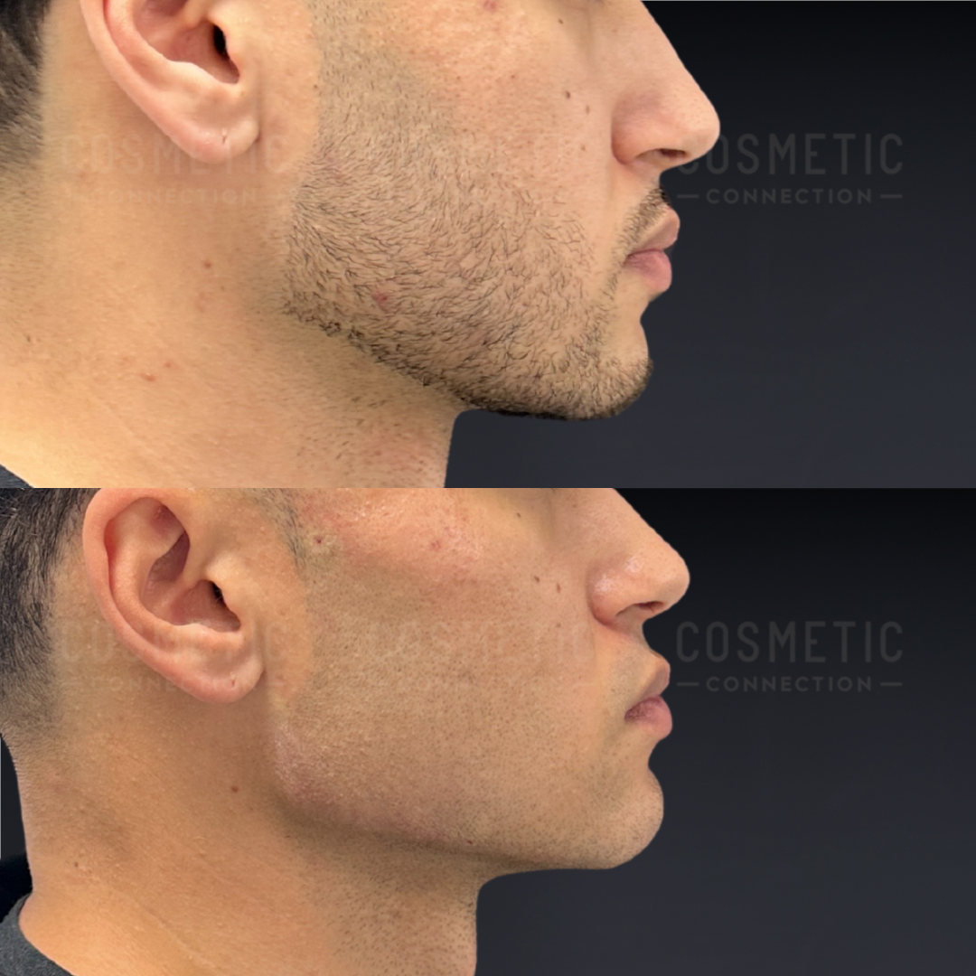 Side-by-side comparison of a mans face before and after a cosmetic procedure. The top image shows a patchy beard and uneven jawline; the bottom image shows a smooth, defined jawline with no facial hair.